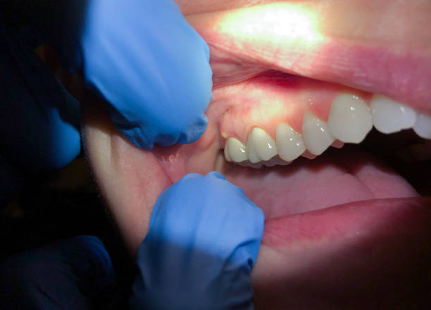 Best Emergency Wisdom Tooth Extraction in Linton Hall, VA